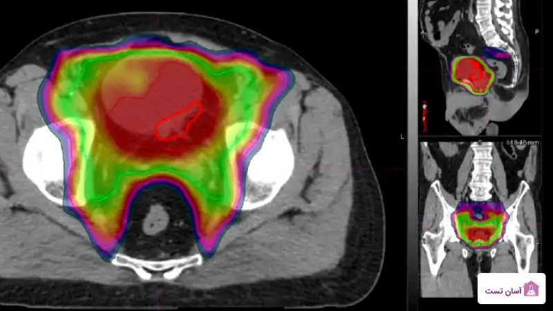 رادیوتراپی برای درمان سرطان مثانه