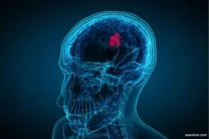 تومورهای غیرسرطان‌زای درون مغز