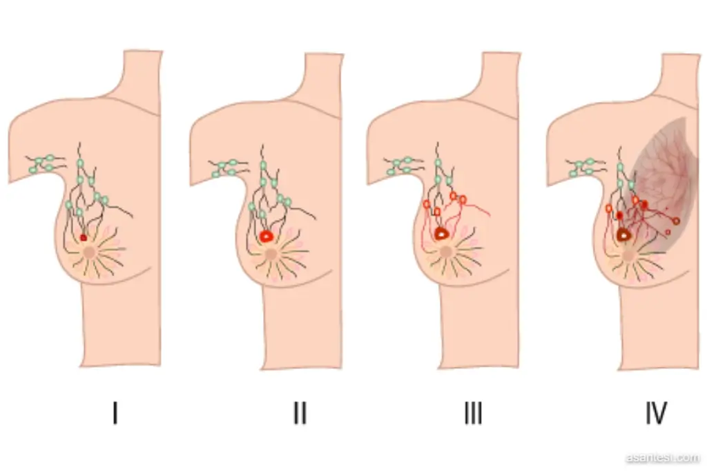مراحل سرطان سینه