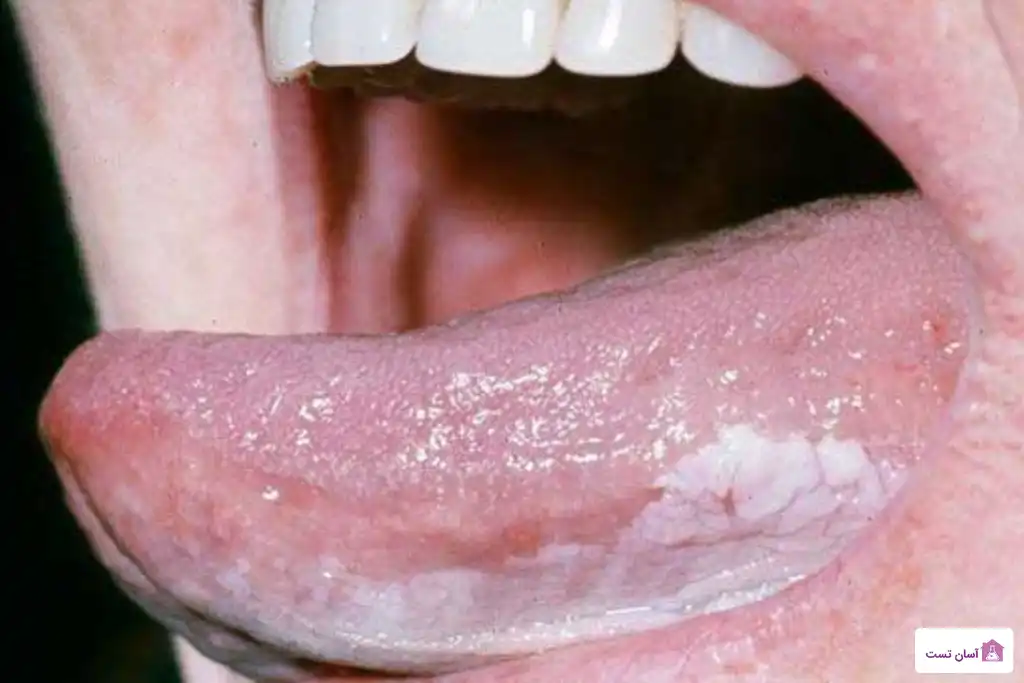 تومورهای زبان